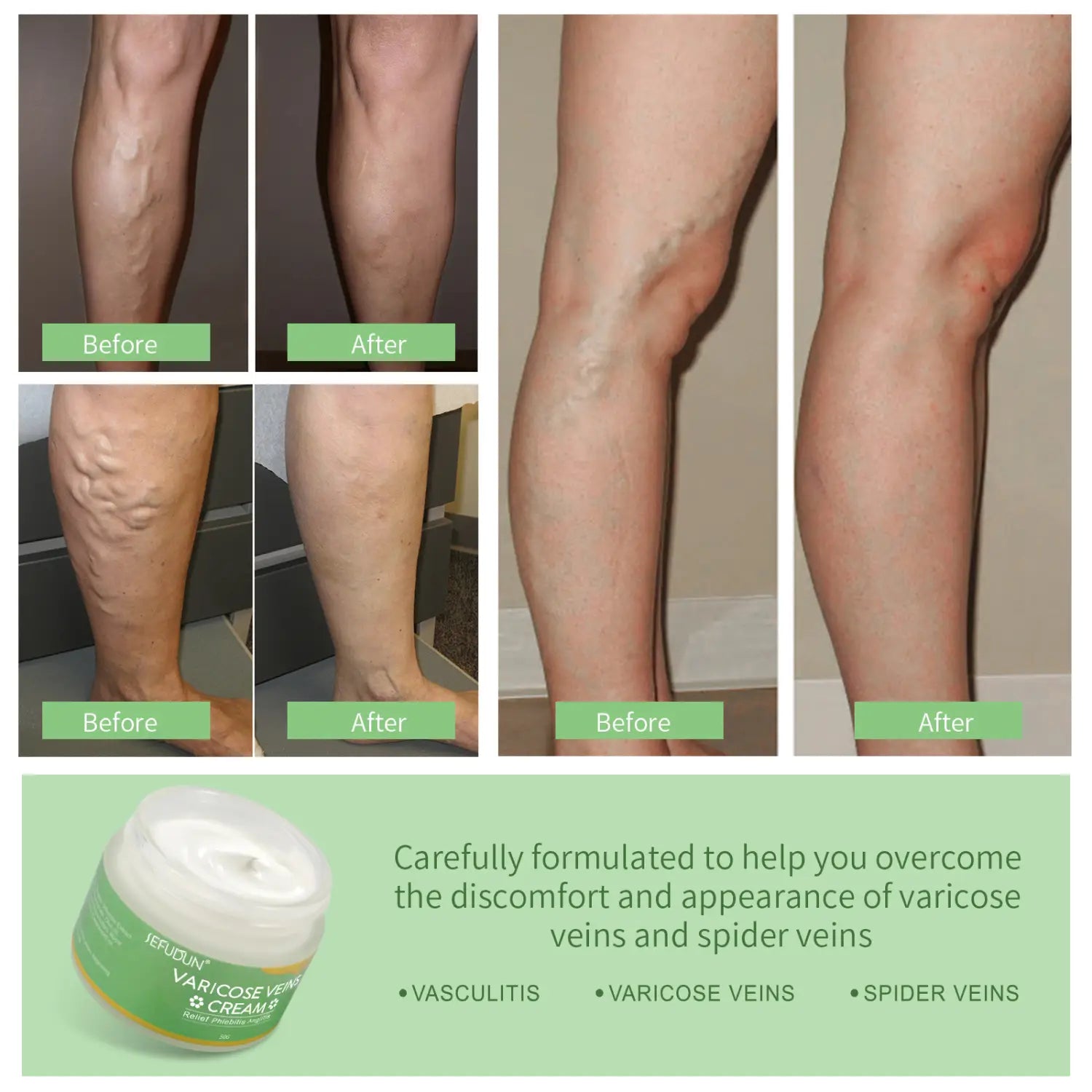 un pot vert et blanc de crème de soulagement des varices de jiefudun pour les douleurs et l’enflure des jambes, présenté depuis le côté arrière