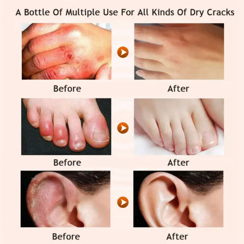 a bottle of moisturizing cream in the honey foot cream and gel sock moisturizing set designed to treat dry cracks on hands feet and ears
