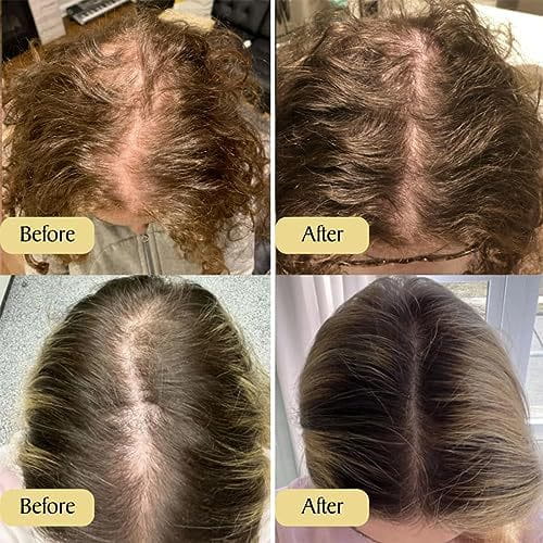 The image shows a before-and-after comparison of hair loss progression from thinning scalp to fuller hair using hair growth oil moisturizing repair serum 60ml.