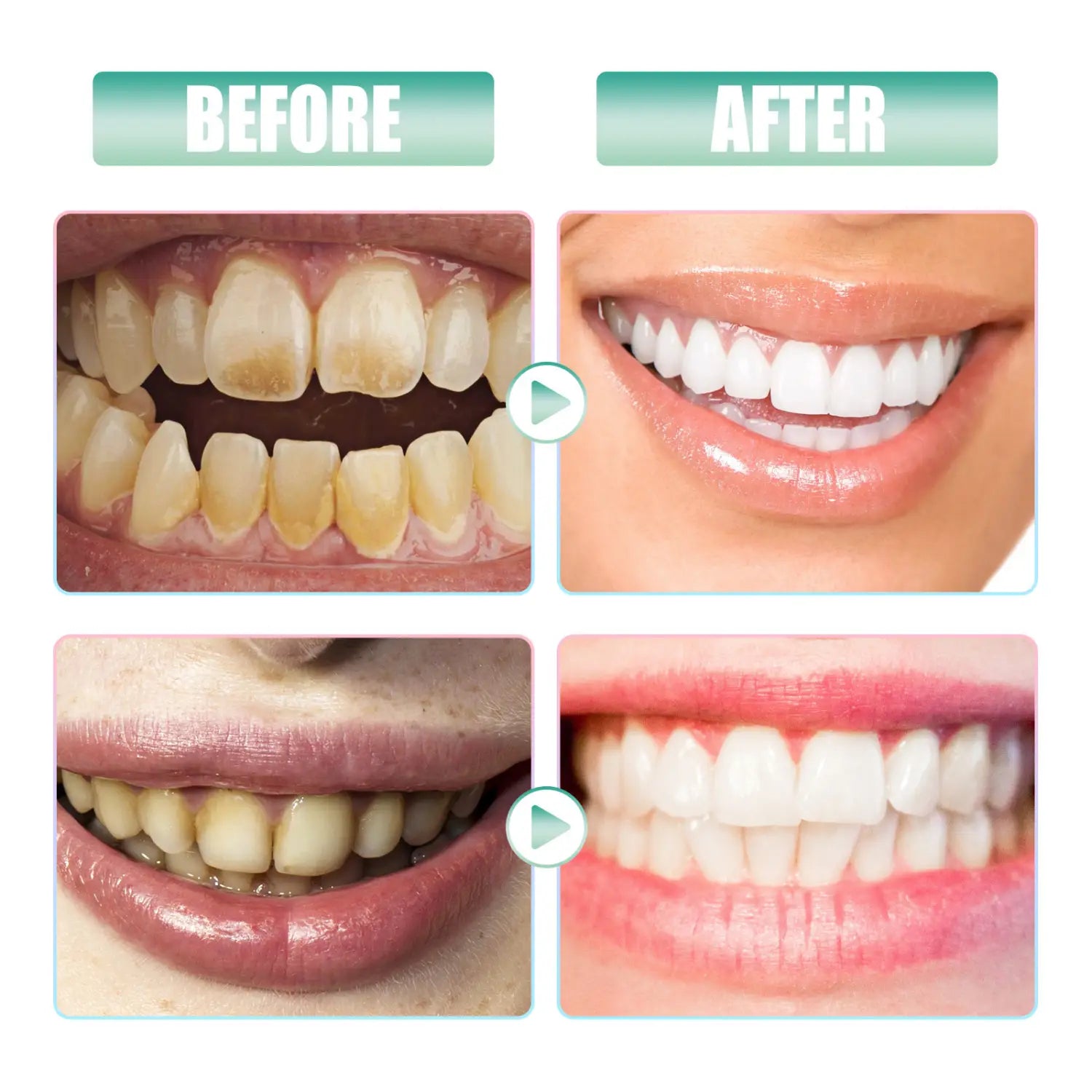 bright white glossy teeth shown in a before and after comparison using nicotinamide teeth whitening toothpaste stain removal 100g for effective dental whitening