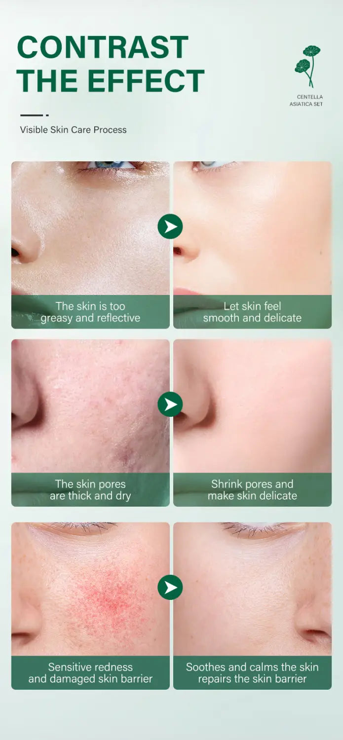 Das Bild zeigt eine Anzeige für ein Hautpflegeprodukt für das Set „candida 4912a“ mit Vorher-nachher-Vergleichen der Hautstruktur, der Porengröße und der Empfindlichkeit im Centella-asiatica-5-teiligen Gesichtspflege-Set von Irev.