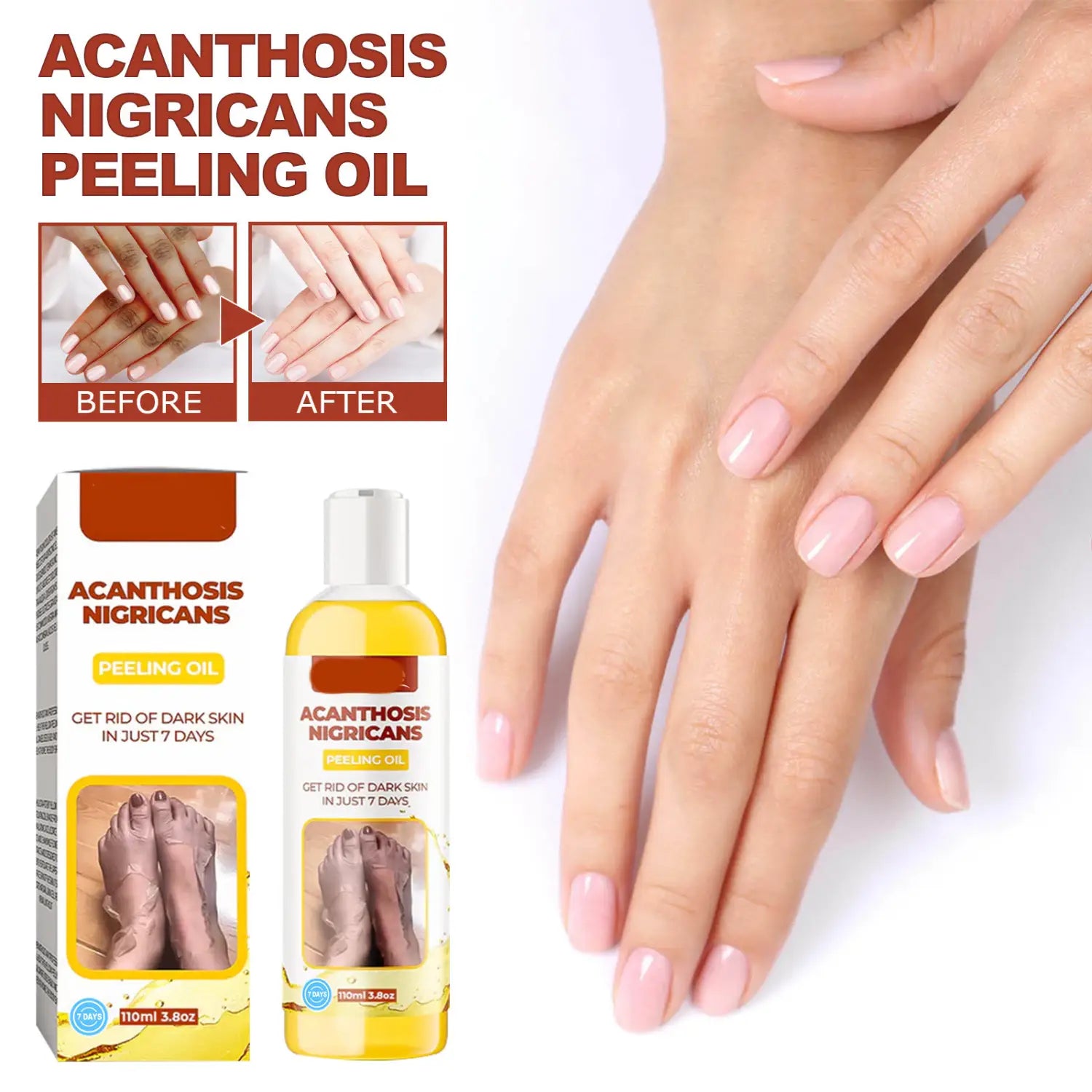 A clear bottle of acanthosis nigricans peeling oil with yellow liquid and white cap next to its matching box for dark spots 110ml.
