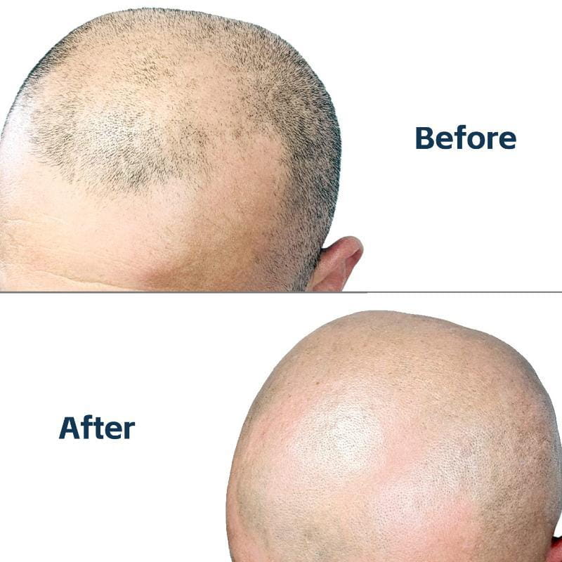 Comparación antes y después que muestra a una persona con cabello escaso y, posteriormente, con una cabeza más abundante, utilizando una afeitadora para arreglo de la calva con correa para el dedo de TPU, diseñada para un aseo de cabeza preciso.