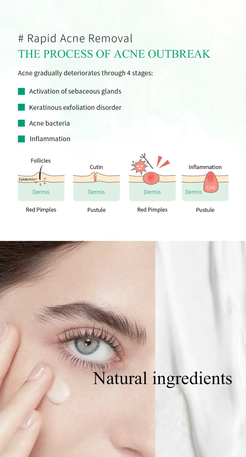 a white creamy tea tree acne treatment gel being applied to the skin with fingers for face and neck use in a 20g tube