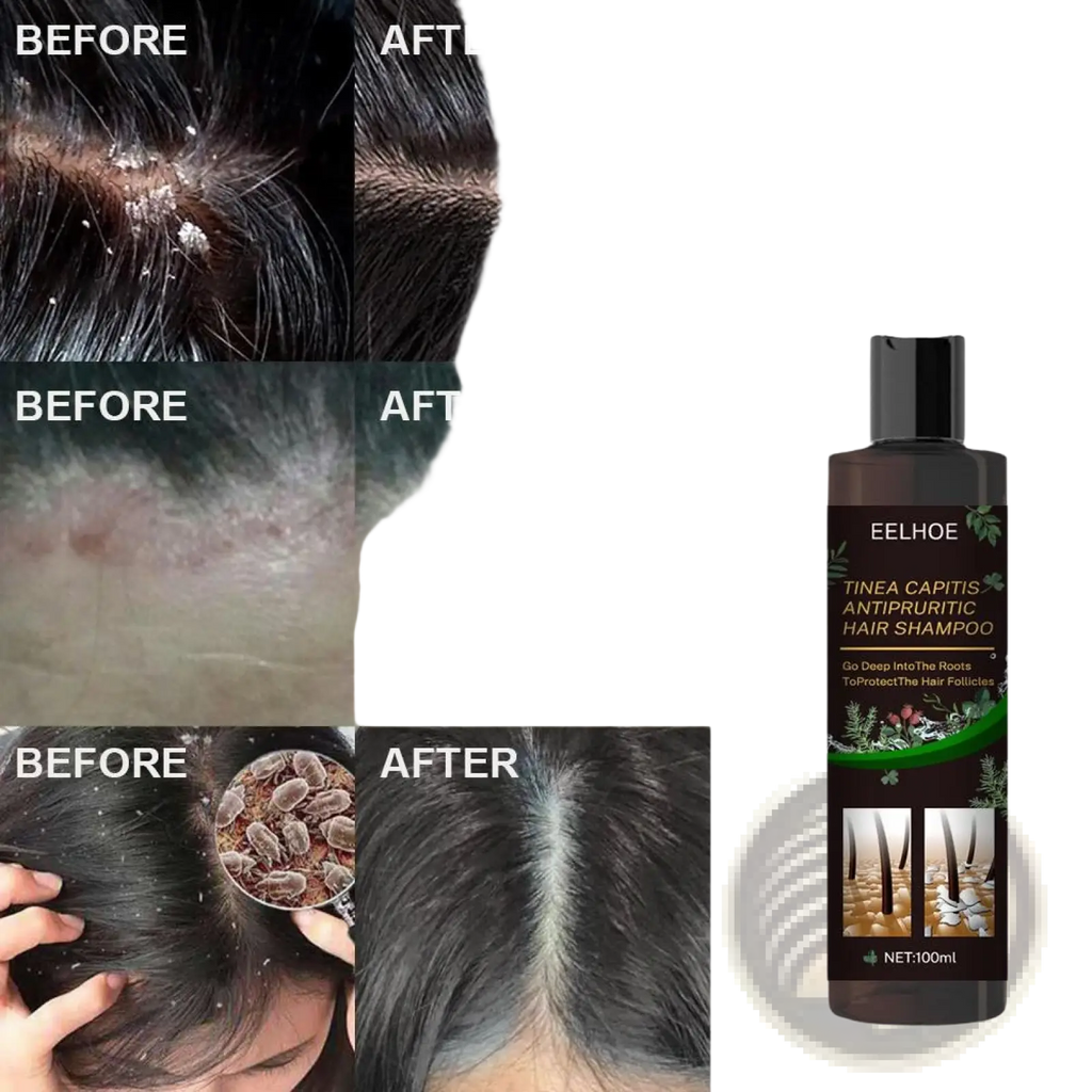 Dark brown bottle of eelhoe tinea capitis antipruritic hair shampoo 100ml for anti-dandruff itch relief and oil control