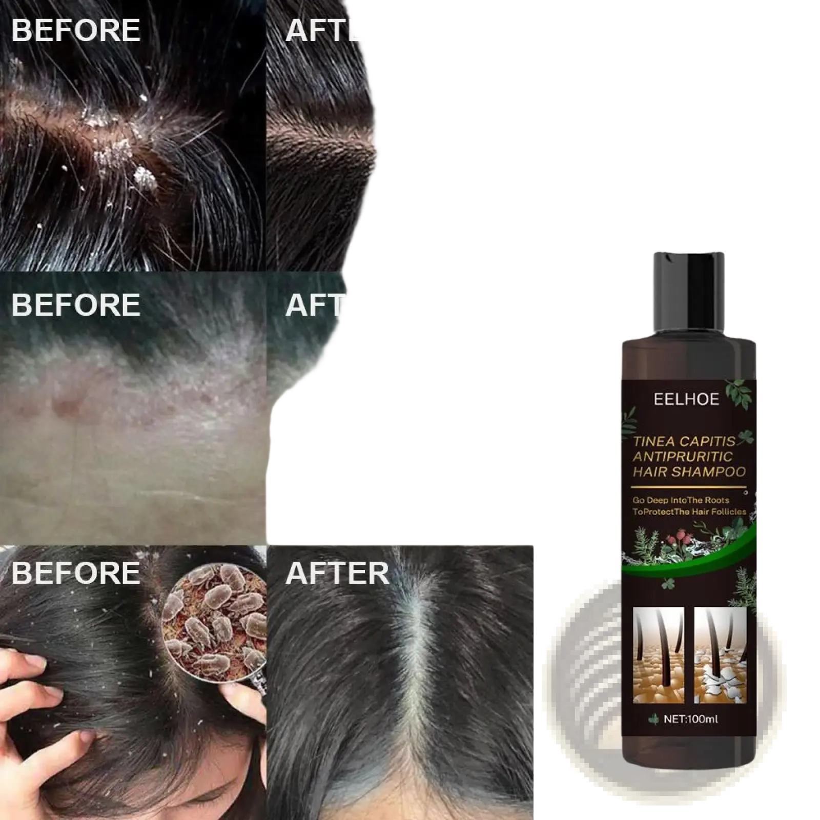 Dark brown bottle of eelhoe tinea capitis antipruritic hair shampoo 100ml for anti-dandruff itch relief and oil control