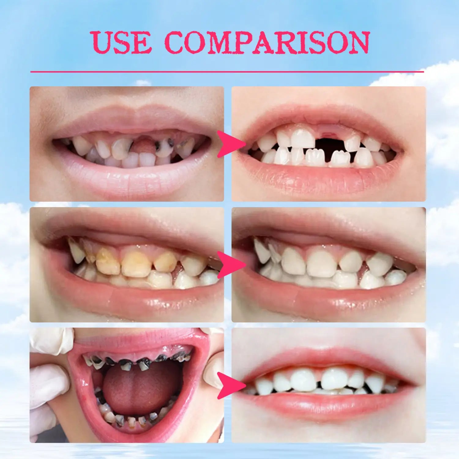 Before-and-after dental smile transformation images showing improved teeth alignment whiteness and oral health using kids foam toothpaste 60ml cavity protection blueberry.