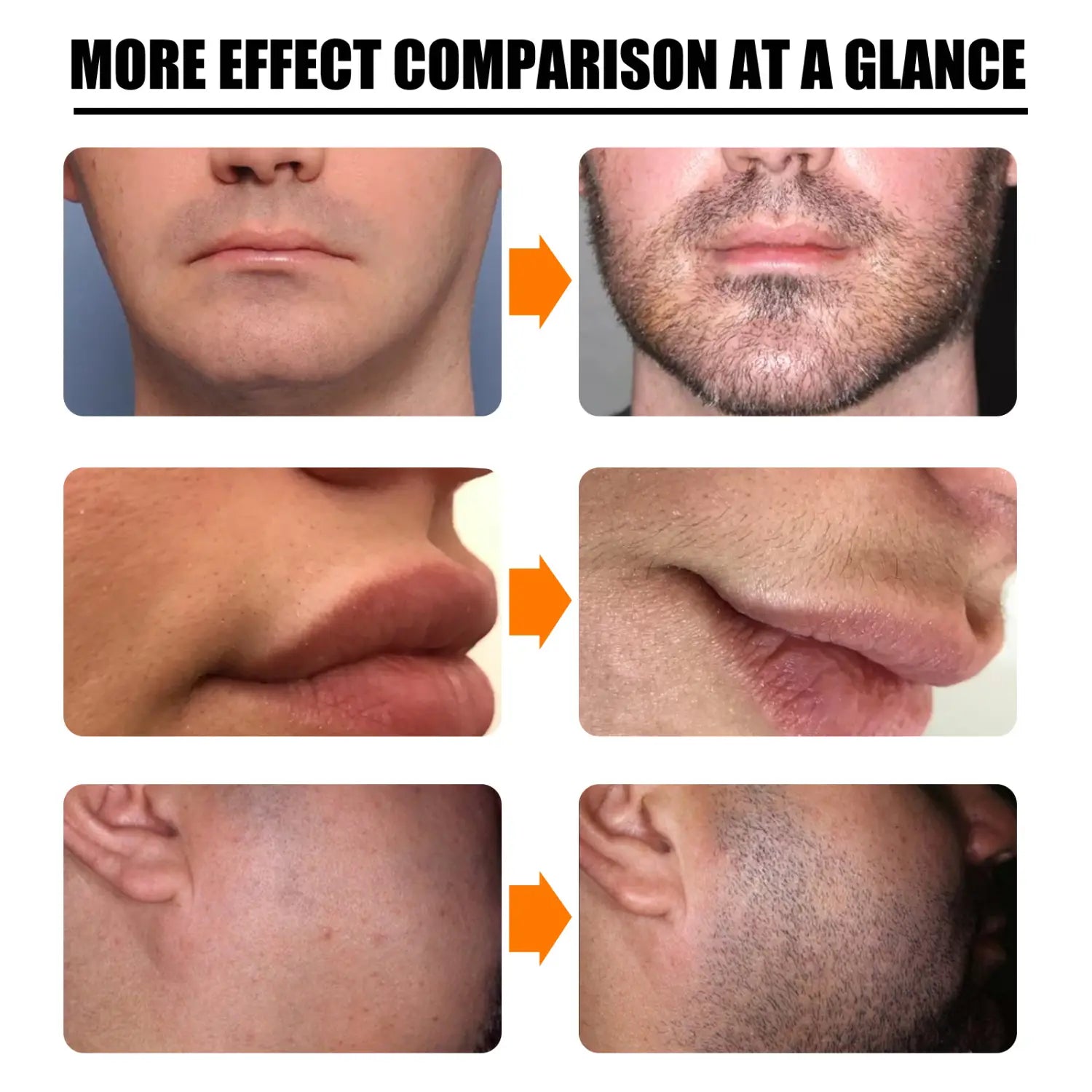 「ひげ育毛スプレーおよびダーマローラーキット30ml」を用いた、ひげ育毛の結果を示すビフォーアンドアフターの比較画像（より高いひげの密度とカバー力の向上のため）。