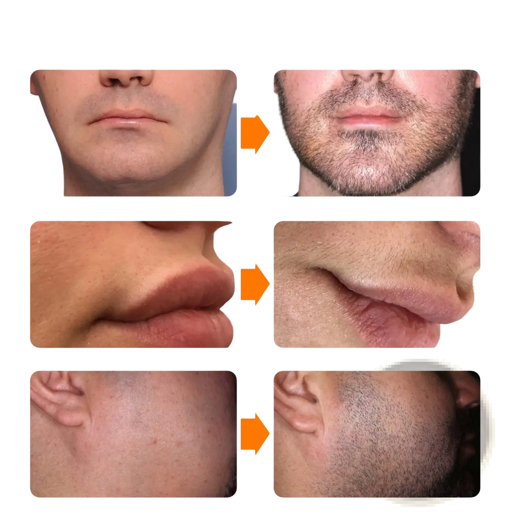 Before and after comparison of facial and body hair removal using beard growth spray and derma roller kit 30ml
