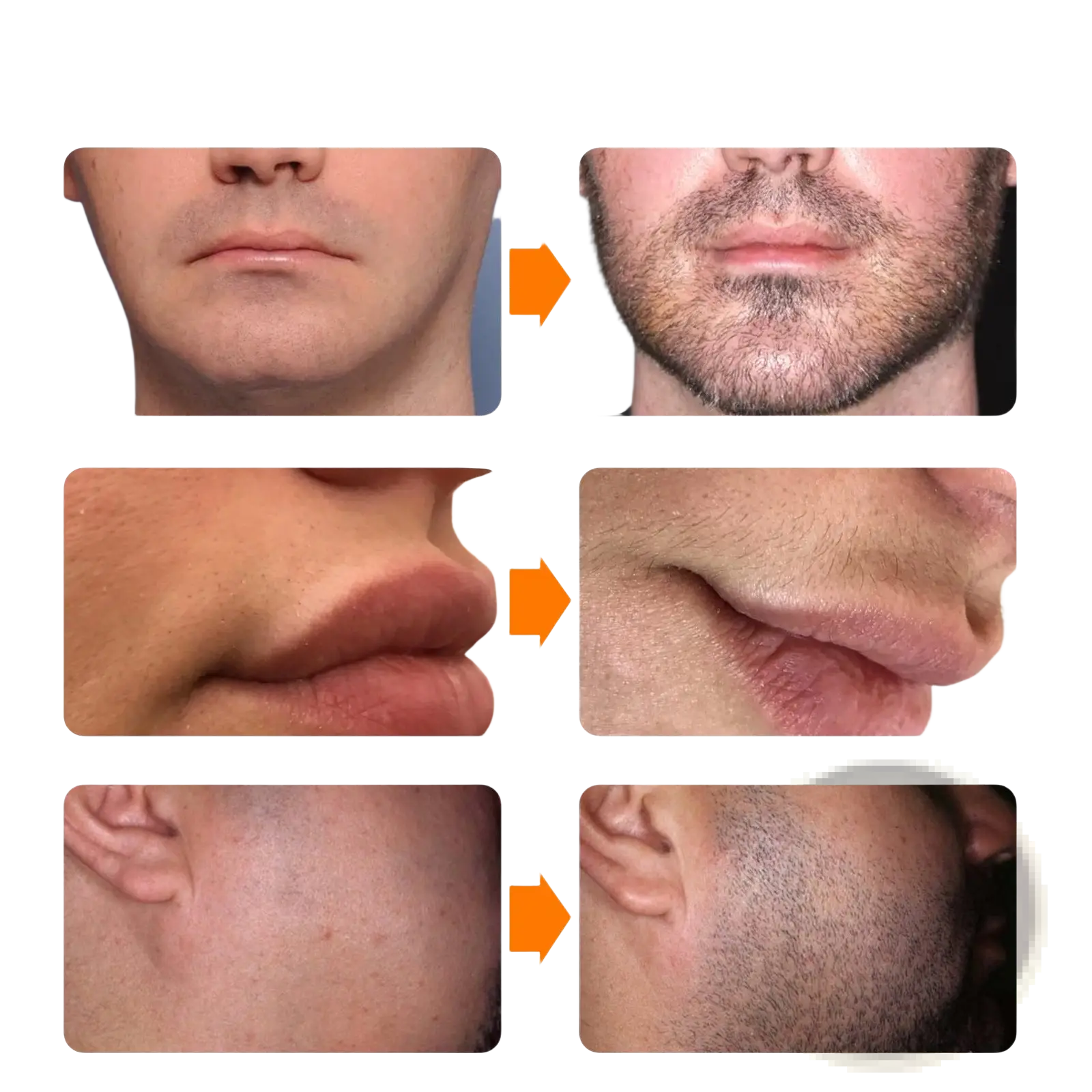Before and after comparison of facial and body hair removal using beard growth spray and derma roller kit 30ml