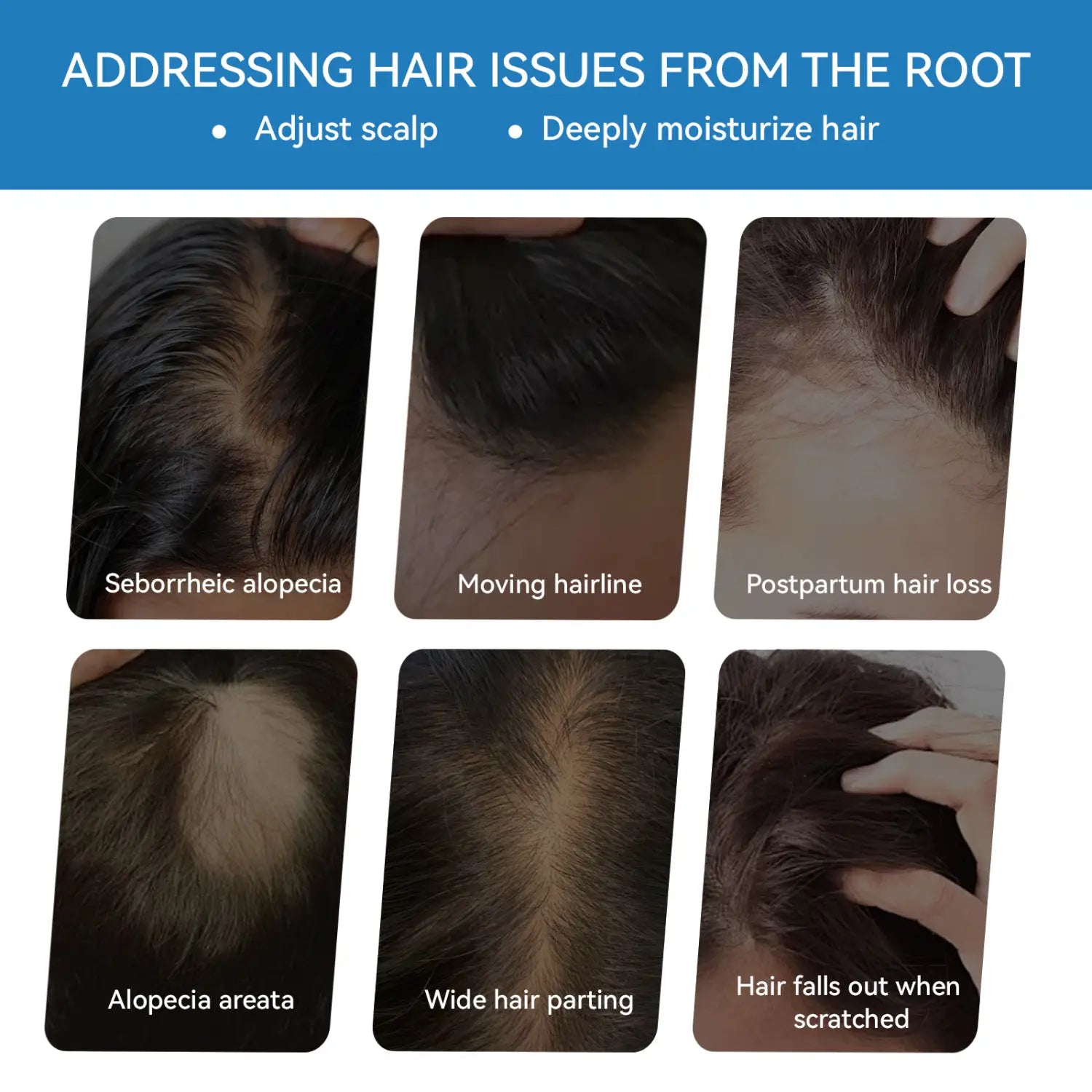 The image shows six close-up photos of various scalp conditions labeled with specific hair loss diagnoses displayed alongside blue copper peptide hair growth serum 30ml packaging.