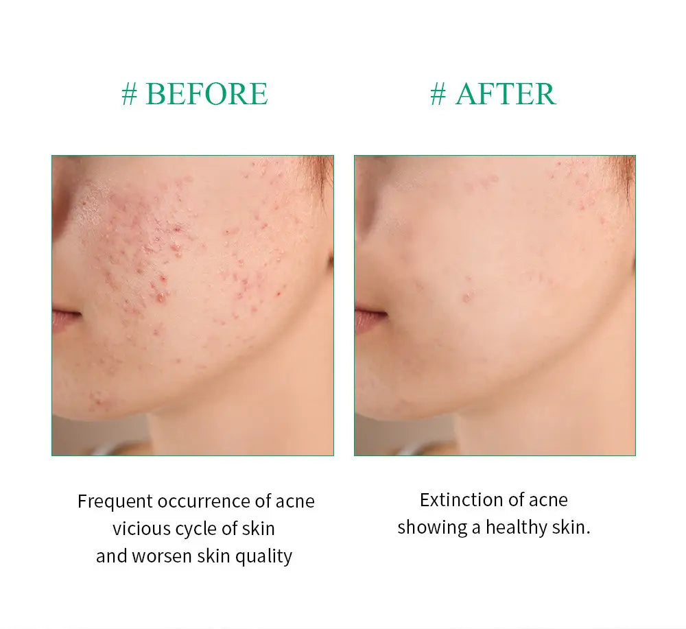 The image shows a before-and-after comparison of acne-prone skin and clear skin using tea tree acne treatment face and neck cream 20g.