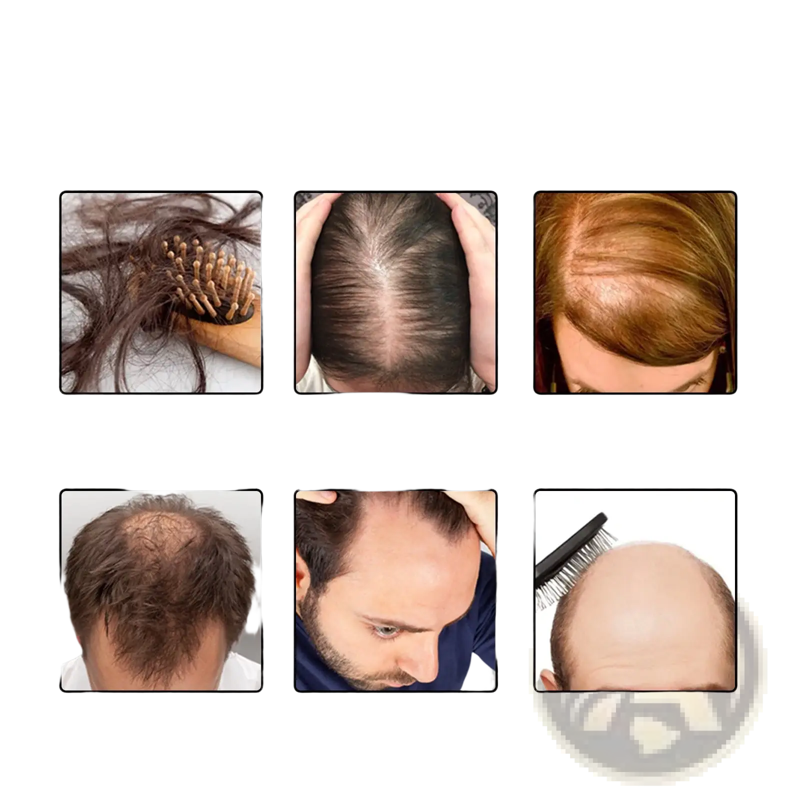 Eelhoe rosemary hair growth oil and dermaroller set with six images showing various hair loss symptoms for treatment