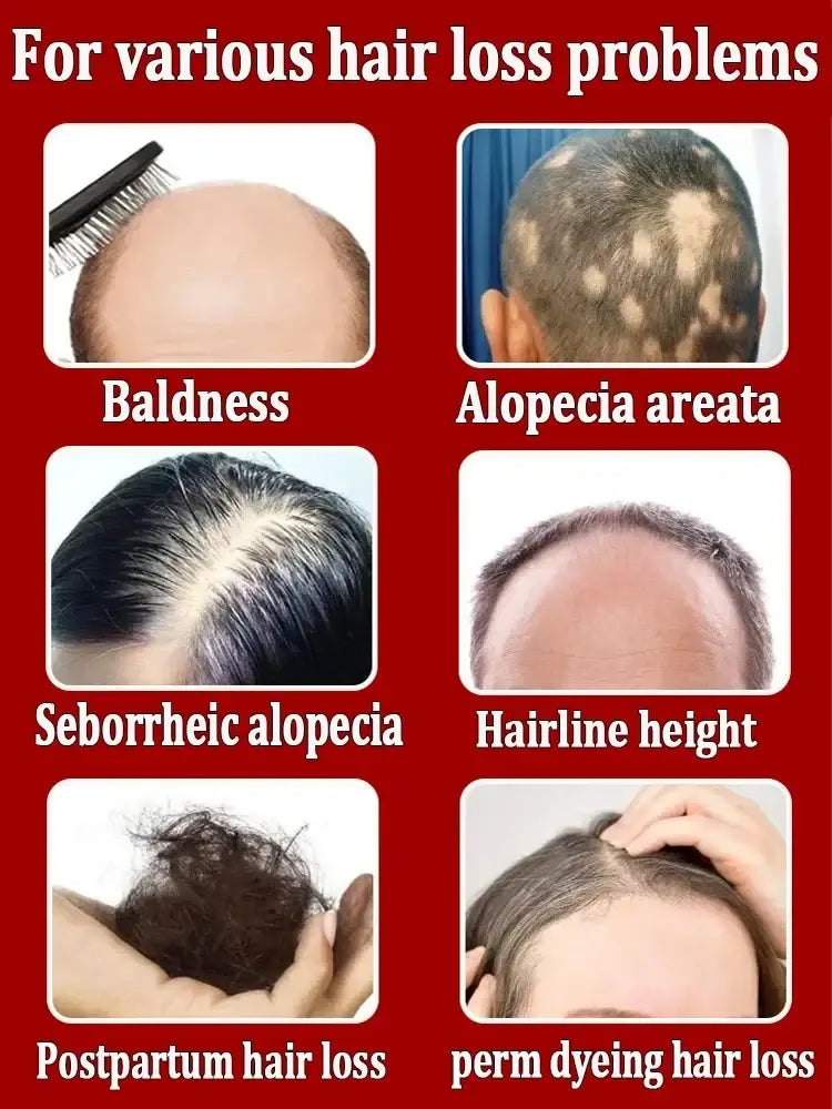 Infographic on red background showing six white-bordered panels of hair loss types for fast hair growth essential oil 30ml