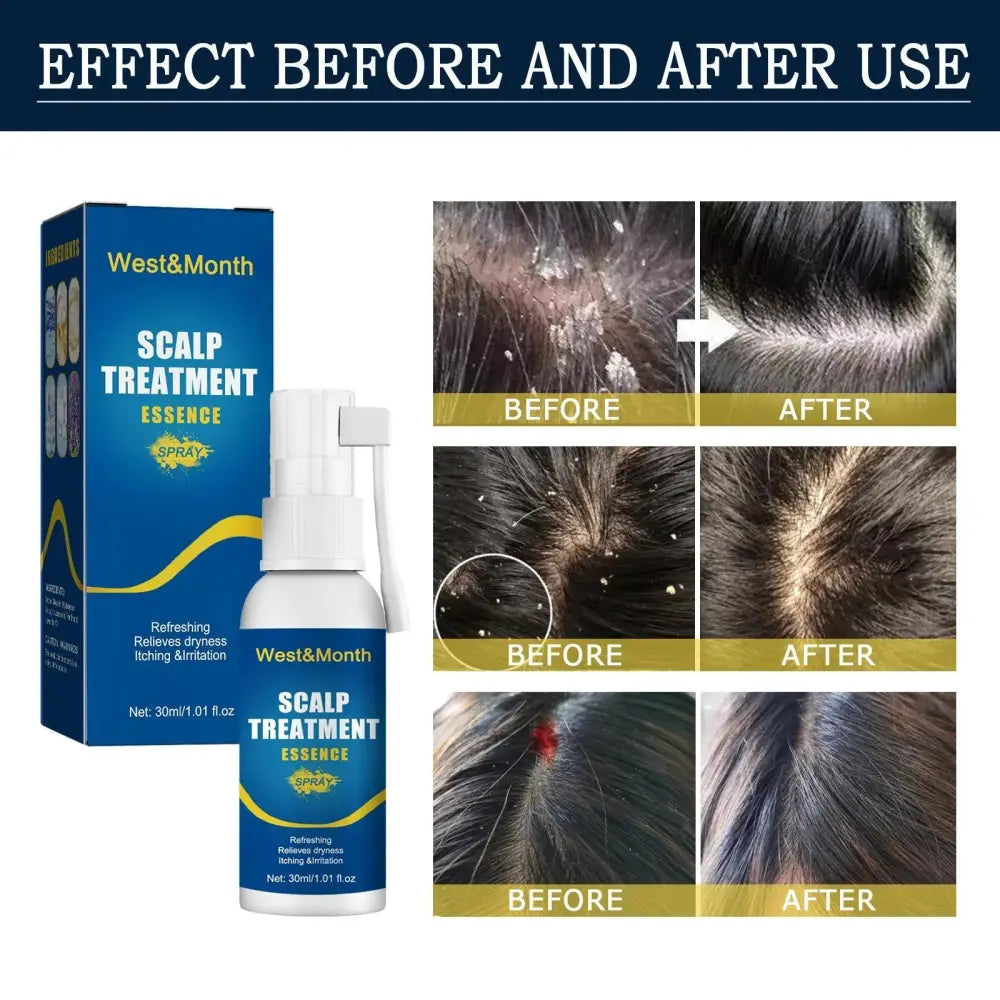 West and month hair follicle root repair essence spray in a white bottle with blue labeling for scalp treatment