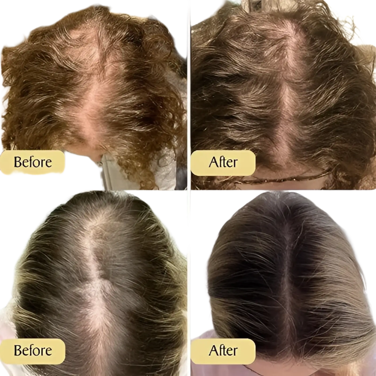 Before and after images showing improved hair density and scalp coverage using hair growth oil moisturizing repair serum 60ml
