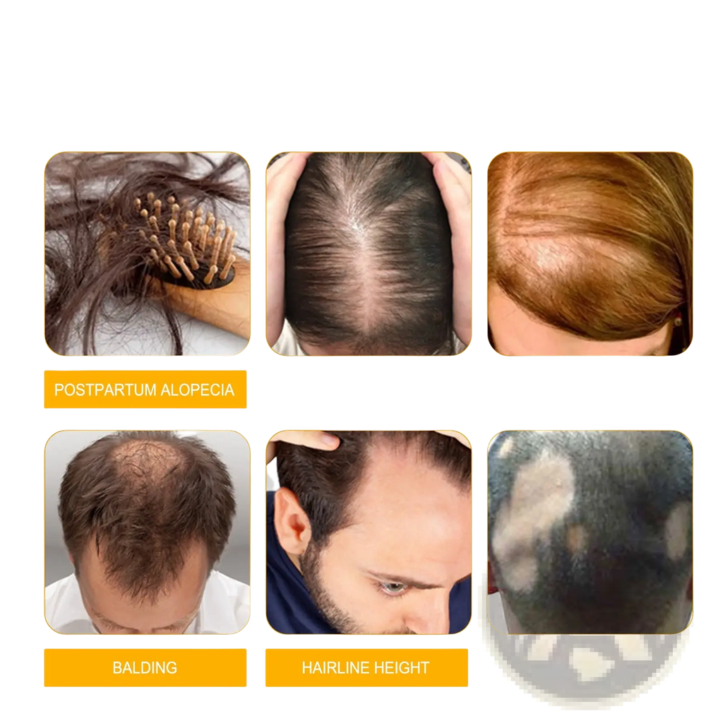 Hair growth serum anti hair fall oil 30ml shown with images of postpartum alopecia perm dyeing hair loss and balding types