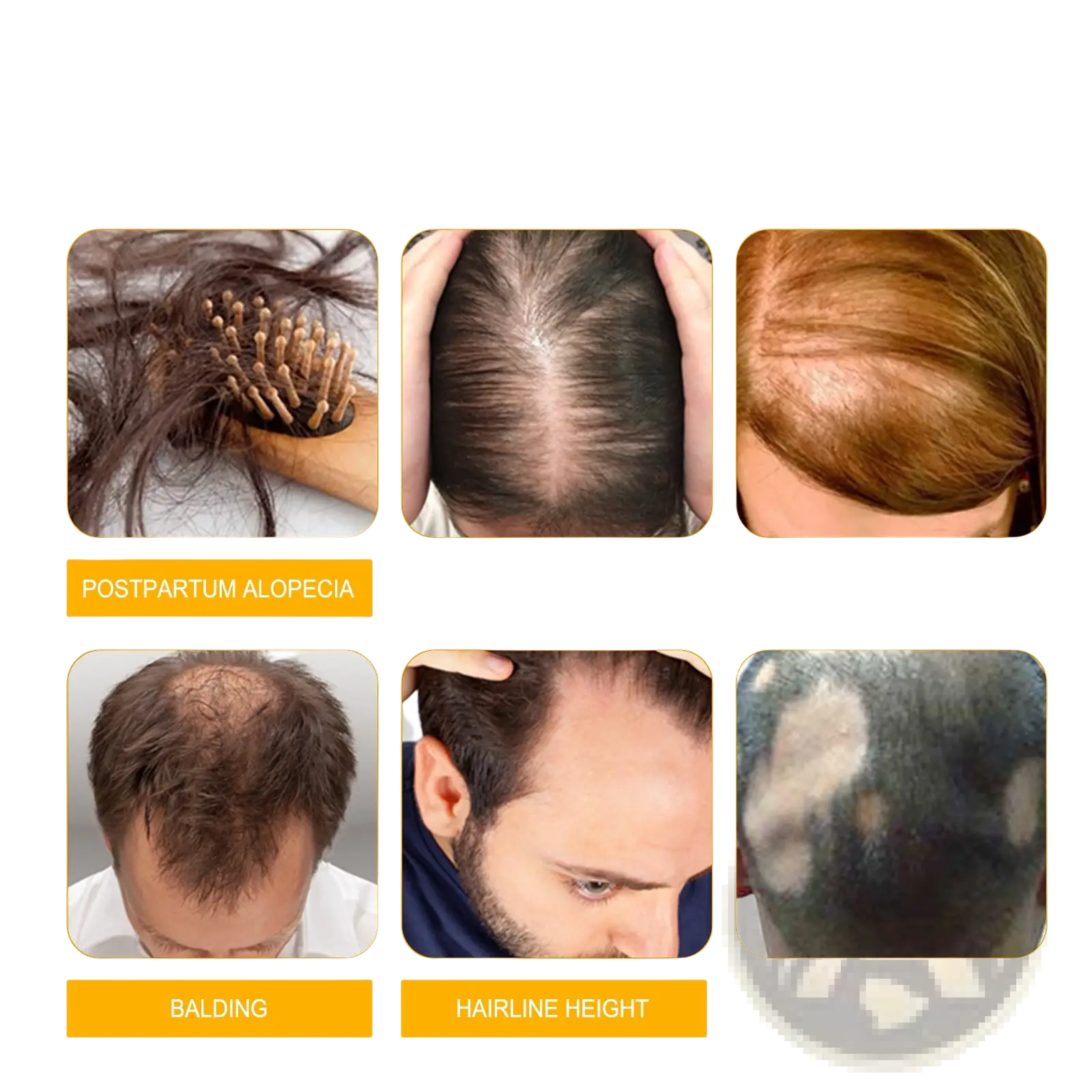 Hair growth serum anti hair fall oil 30ml shown with images of postpartum alopecia perm dyeing hair loss and balding types