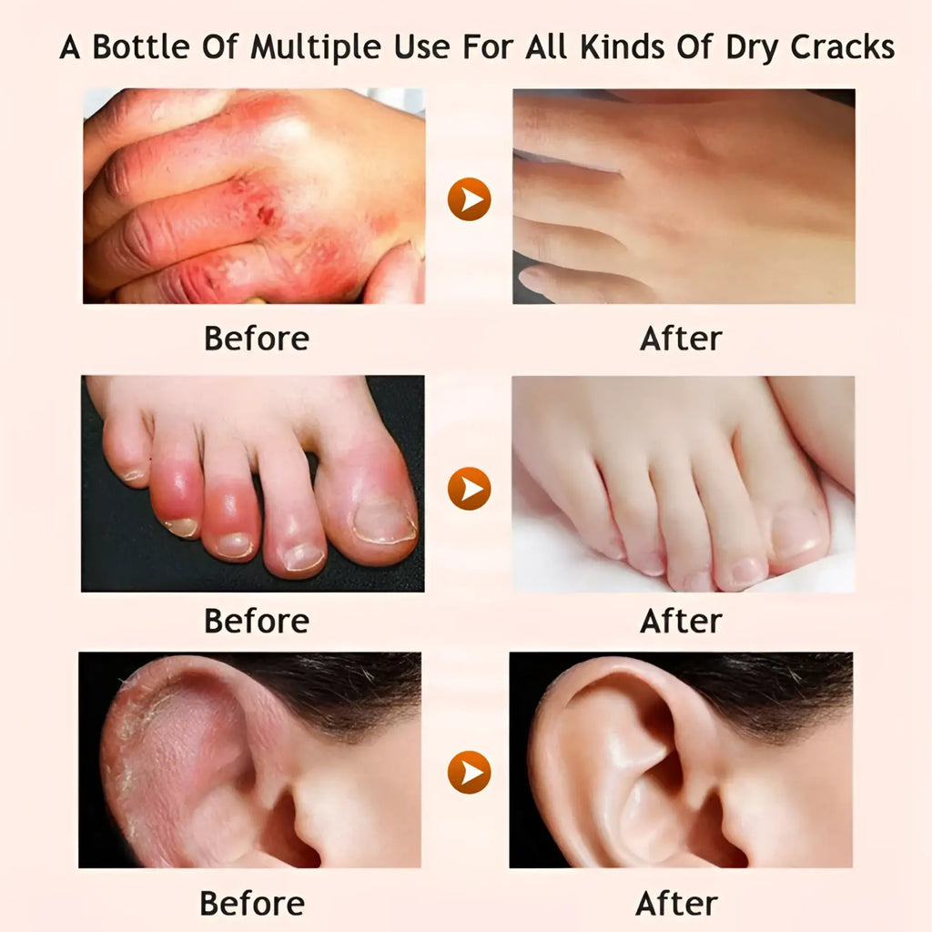 A bottle of honey foot cream moisturizing set designed to treat dry cracks on hands feet and ears