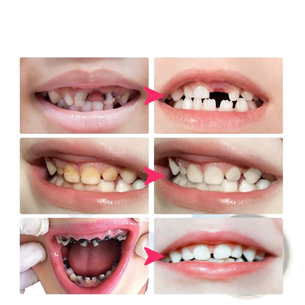 Before-and-after dental photos showing improved teeth alignment and whiteness using kids foam toothpaste 60ml blueberry