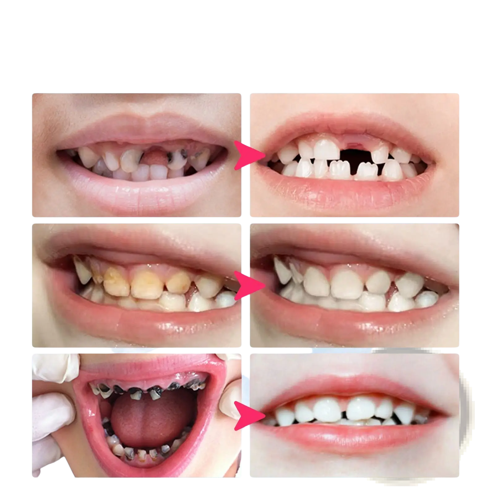 Before-and-after dental photos showing improved teeth alignment and whiteness using kids foam toothpaste 60ml blueberry