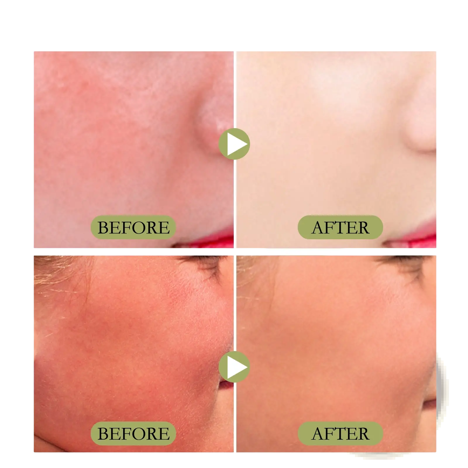 Before and after comparison of skin showing transformation from redness to clear smooth skin with matte sun stick spf 50 moisturizing skincare cream