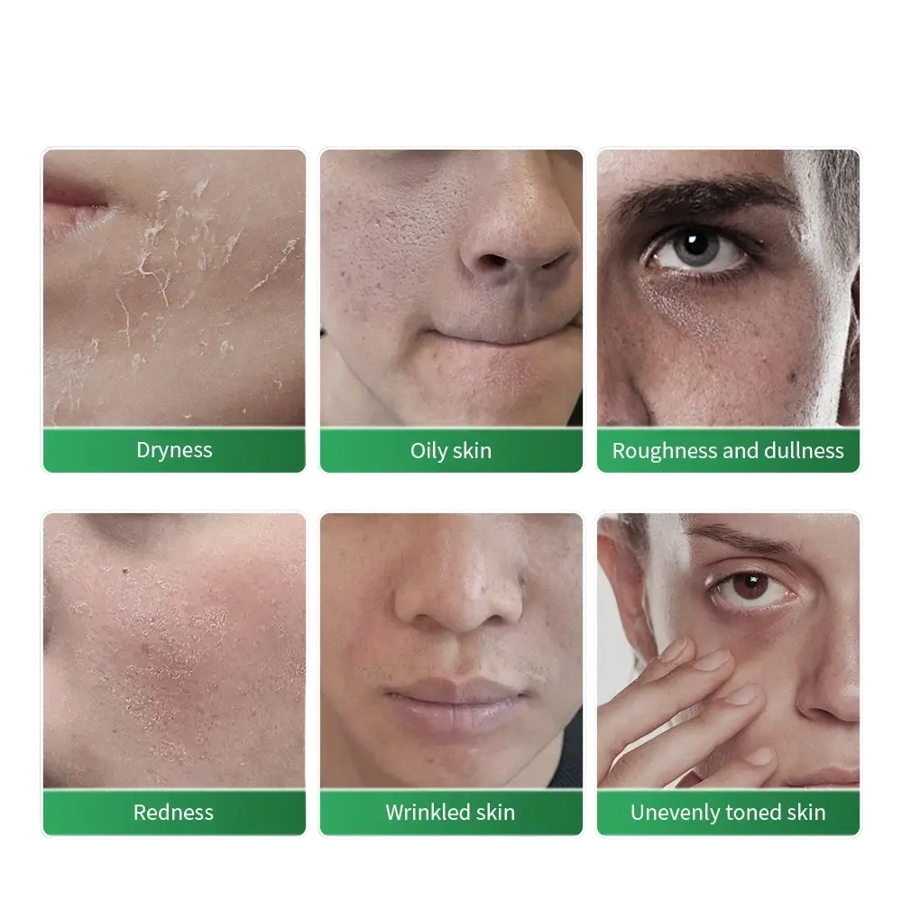 Diagnostic images of skin problems including dryness oily skin roughness redness and wrinkles for men’s facial moisturizer 22ml × 1pc 15ml × 1pc