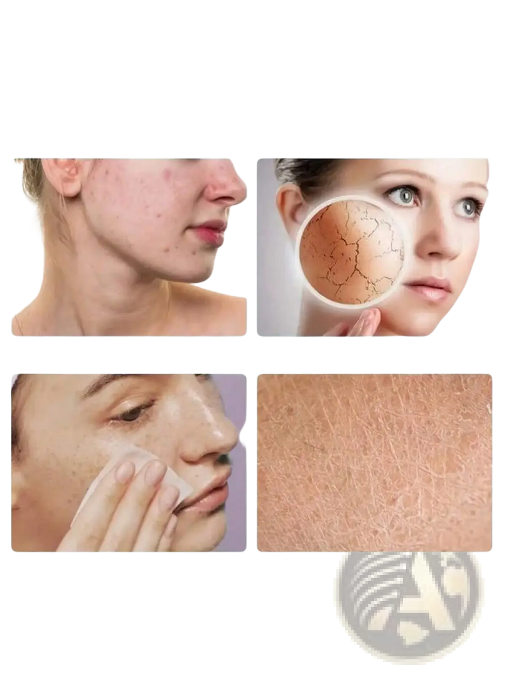 Image showing a portable rechargeable nano mist facial hydration nebulizer and four skin conditions acne dry peeling oil off and dead skin keratin