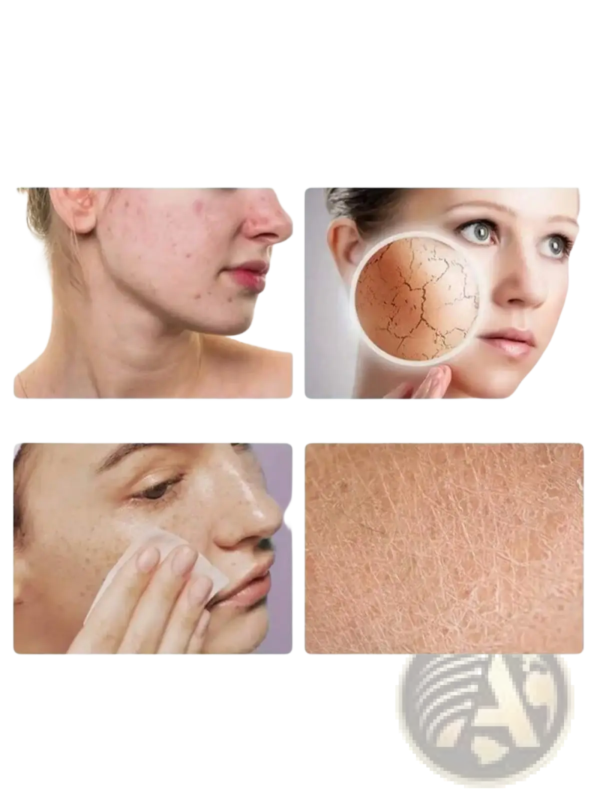 Image showing a portable rechargeable nano mist facial hydration nebulizer and four skin conditions acne dry peeling oil off and dead skin keratin